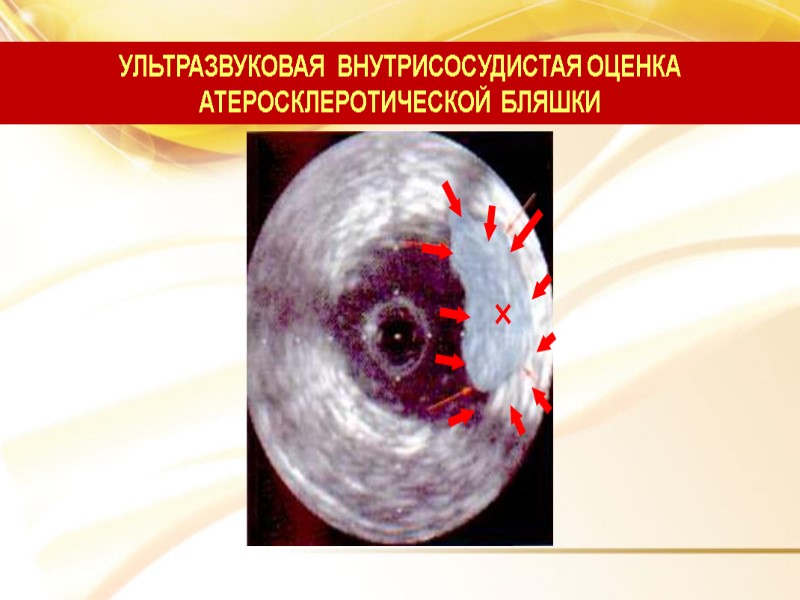 УЛЬТРАЗВУКОВАЯ  ВНУТРИСОСУДИСТАЯ ОЦЕНКА  АТЕРОСКЛЕРОТИЧЕСКОЙ  БЛЯШКИ